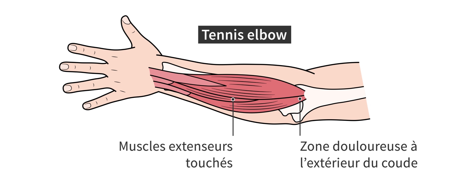 musculation tendinite coude